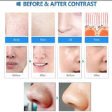 Peeg Microdermabrasion Blackhead Remover Vacuum Cleaner Warts Skin Tag Removal Dia Tip Facial Cleaning Care