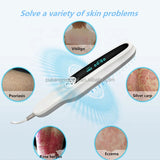 hot selg handheld phototherapy 311nm narrow band uvb lamps for psoriasis vitiligo