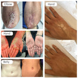 311nm UVB Phototherapy Device Unit Home Use SIGMA SH1B with LCD Timer Treatment of Vitiligo and Psoriasis