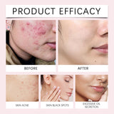 40pcs Turmeric Kojic Acid Cleansing Unclog Pores Balance Oil Exfoliating Pads For Face Body Skin Care