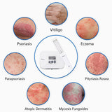 311nm UVB Phototherapy Device Unit Home Use SIGMA SH1B with LCD Timer Treatment of Vitiligo and Psoriasis