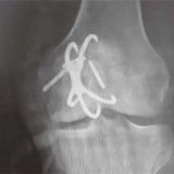 Professional New Patellar Fixator Titanium Internal Fixation for Hospitals Medical Suppliers