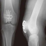 Professional New Patellar Fixator Titanium Internal Fixation for Hospitals Medical Suppliers