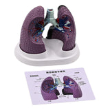 (Chinese description) Anatomical Pathological Lung Model Normal and Pathological Lung Anatomy Model for Teaching Research Clinical Settings