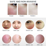 Red Blood Vessel Spots Vascular Removal Beauty Equipment High Frequency Needle RF Spider Veins Removal Anti Redness Machine
