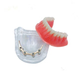 Overdenture implant model Denture Teeth mandibular model with golden bar Dental Teaching Model