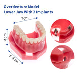 Dental Implant Restoration Teeth Model Removable Bridge Denture Teaching research model