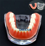 Overdenture implant model Denture Teeth mandibular model with golden bar Dental Teaching Model