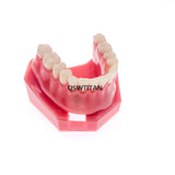 Dental Implant Restoration Teeth Model Removable Bridge Denture Teaching research model