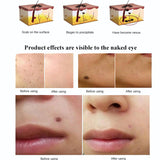 2 in 1 Ozone Skin Rejuvenation Face Lifting Plasma Pen mole remover plasma pen beauty plasma pen Pigment Removal, Dark Circles