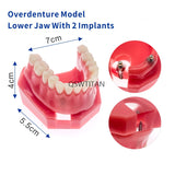 Dental Implant Restoration Teeth Model Removable Bridge Denture Teaching research model