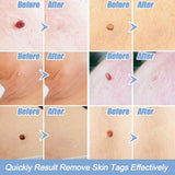 Auto Micro Skin Tag Remover Painless Facial Beauty Tools Mole Wart Spot Skin Tag Removal Kit With Cleansing Swabs Home Use