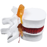 1 Pcs Skeleton Spine Lumbar Disc Herniation Teaching Model &amp; 1 Pcs Human Anatomy Skeleton Spine Vertebral Model