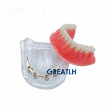 Overdenture implant model Denture Teeth mandibular model with golden bar Dental Teaching Model