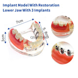 Dental Implant Restoration Teeth Model Removable Bridge Denture Teaching research model