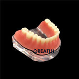 Overdenture implant model Denture Teeth mandibular model with golden bar Dental Teaching Model